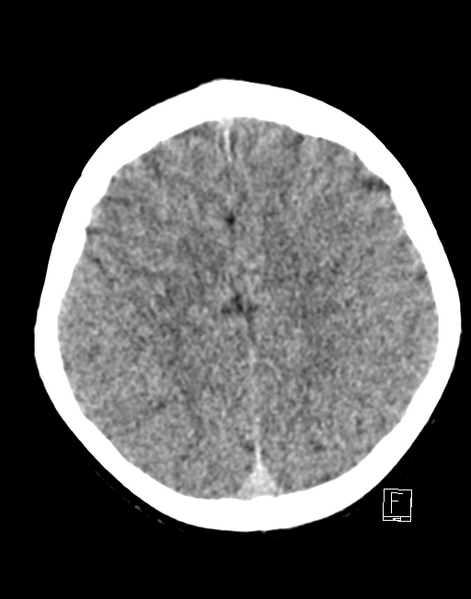 File:Cerebellar stroke (Radiopaedia 32202-33149 Axial non-contrast 22).png