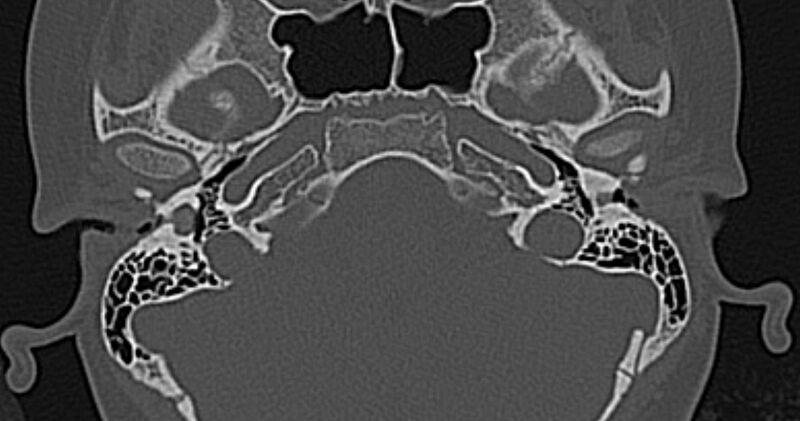 File:Cerebellopontine angle lipoma (Radiopaedia 57303-64242 Axial bone window 16).jpg