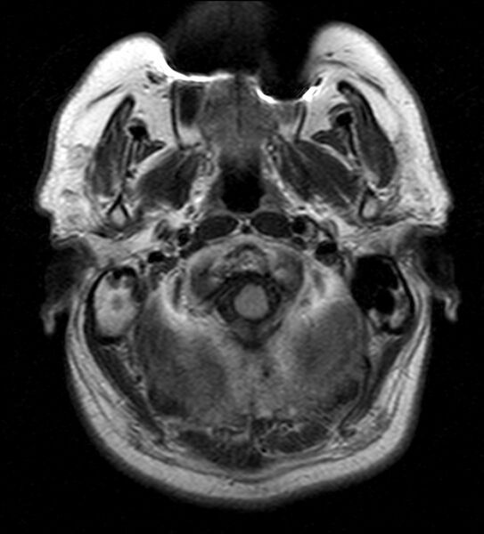 File:Cerebellopontine angle meningioma (Radiopaedia 24459-24764 Axial FLAIR 2).jpg