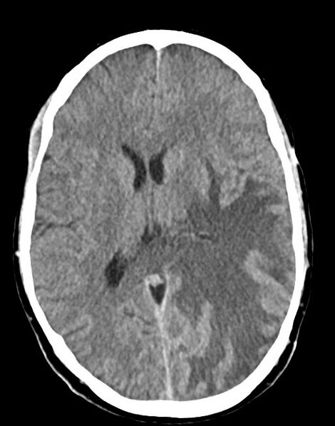 File:Cerebral abscesses (Radiopaedia 70458-80568 Axial non-contrast 35).jpg