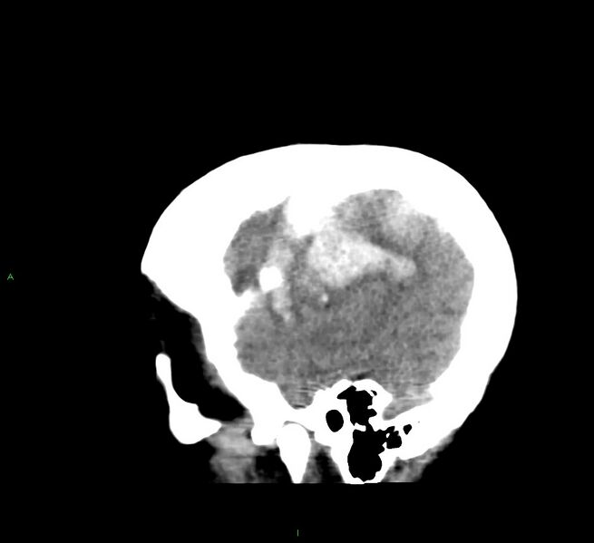 File:Cerebral amyloid angiopathy-associated lobar intracerebral hemorrhage (Radiopaedia 58379-65519 C 9).jpg