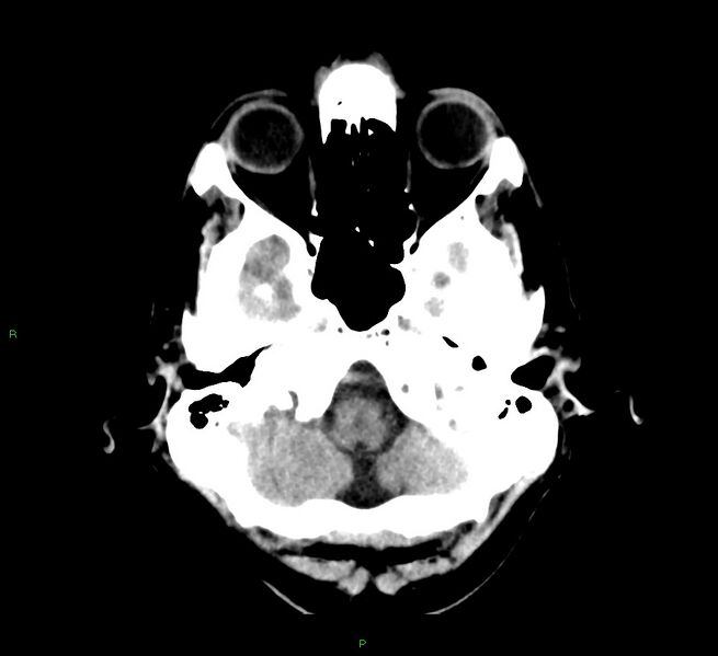 File:Cerebral amyloid angiopathy-associated lobar intracerebral hemorrhage (Radiopaedia 58529-65687 Axial non-contrast 43).jpg