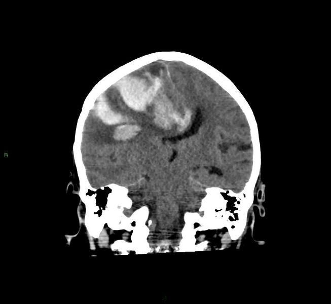 File:Cerebral amyloid angiopathy-associated lobar intracerebral hemorrhage (Radiopaedia 58560-65723 Coronal non-contrast 34).jpg