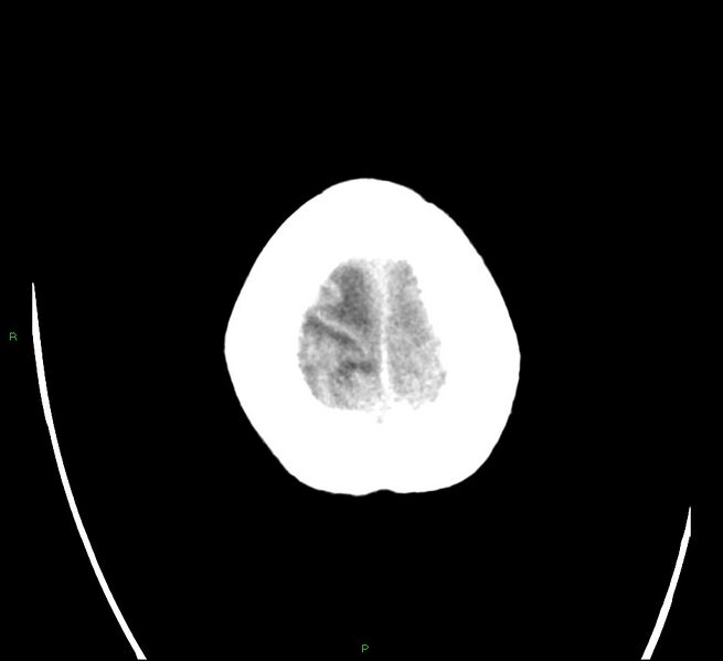 File:Cerebral amyloid angiopathy-associated lobar intracerebral hemorrhage (Radiopaedia 58566-65731 Axial non-contrast 25).jpg