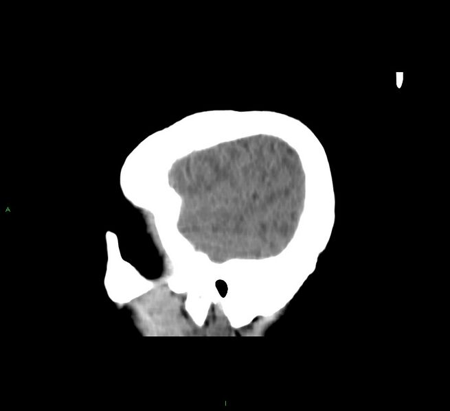 File:Cerebral amyloid angiopathy-associated lobar intracerebral hemorrhage (Radiopaedia 58751-65972 C 46).jpg