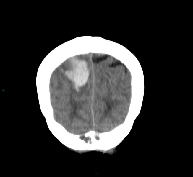 File:Cerebral amyloid angiopathy-associated lobar intracerebral hemorrhage (Radiopaedia 58751-65972 Coronal non-contrast 10).jpg