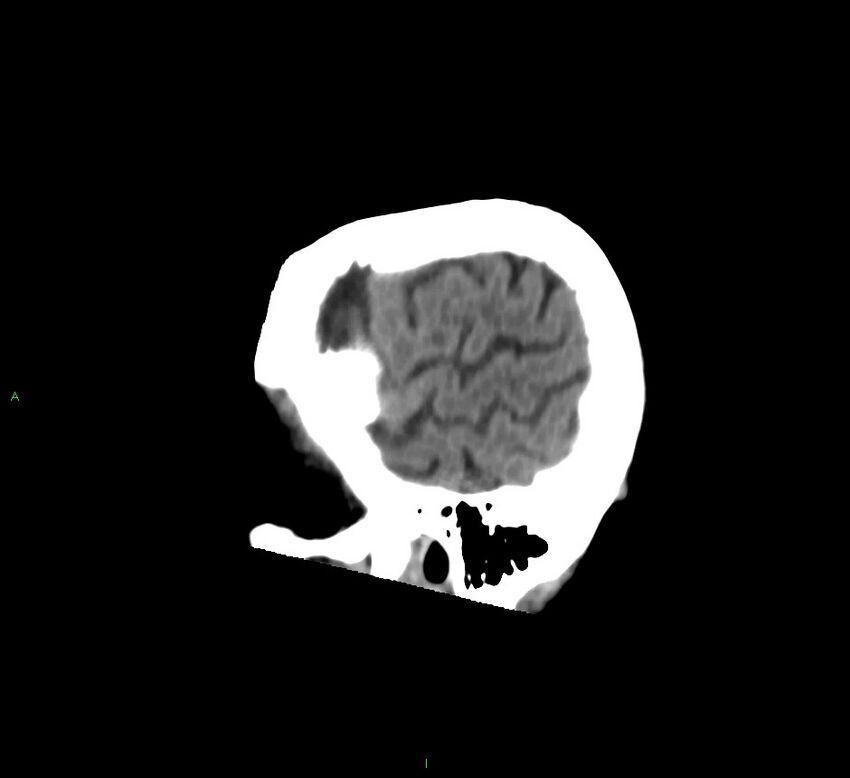 Cerebral amyloid angiopathy-associated lobar intracerebral hemorrhage (Radiopaedia 58758-65980 C 47).jpg