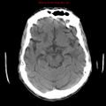 Cerebral and orbital tuberculomas (Radiopaedia 13308-13310 Axial non-contrast 11).jpg