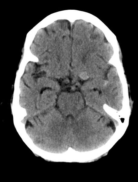 File:Cerebral aneurysm with rupture (Radiopaedia 29933-30457 Axial non-contrast 8).jpg