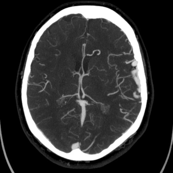 File:Cerebral arteriovenous malformation (Radiopaedia 43729-47189 B 27).jpg