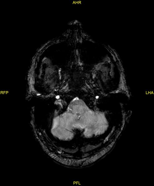File:Cerebral autosomal dominant arteriopathy with subcortical infarcts and leukoencephalopathy (CADASIL) (Radiopaedia 86108-102054 Axial SWI 18).jpg