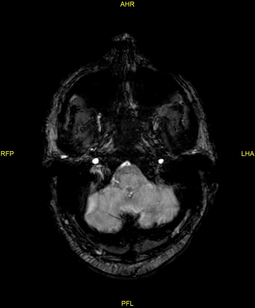 Cerebral autosomal dominant arteriopathy with subcortical infarcts and leukoencephalopathy (CADASIL) (Radiopaedia 86108-102054 Axial SWI 18).jpg