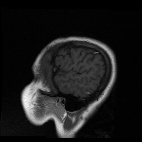 File:Cerebral cavernous malformation (Radiopaedia 44301-47942 Sagittal T1 1).jpg