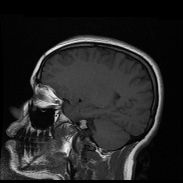 File:Cerebral cavernous malformation (Radiopaedia 44301-47942 Sagittal T1 14).jpg