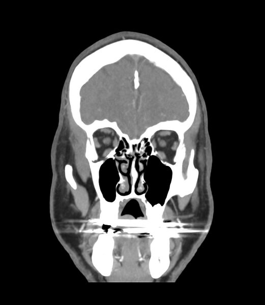 File:Cerebral dural venous sinus thrombosis (Radiopaedia 86514-102576 B 8).jpg