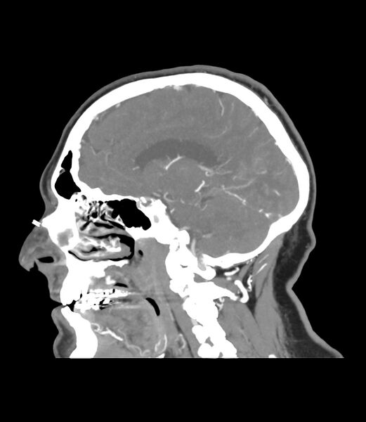File:Cerebral dural venous sinus thrombosis (Radiopaedia 86514-102576 C 33).jpg