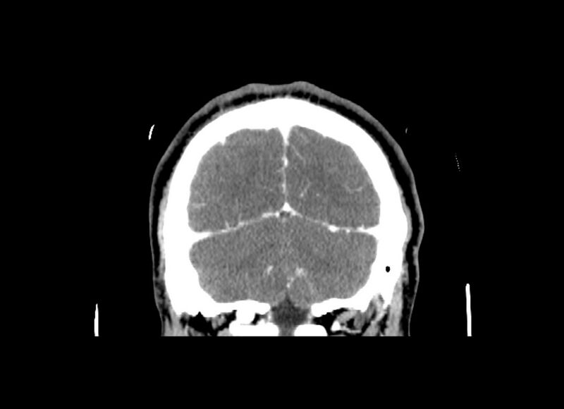 File:Cerebral edema (Radiopaedia 82519-96661 C 15).jpg