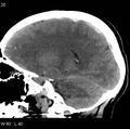 Cerebral hemorrhagic contusion with subdural and subarachnoid hemorrhage (Radiopaedia 10680-11146 C 13).jpg