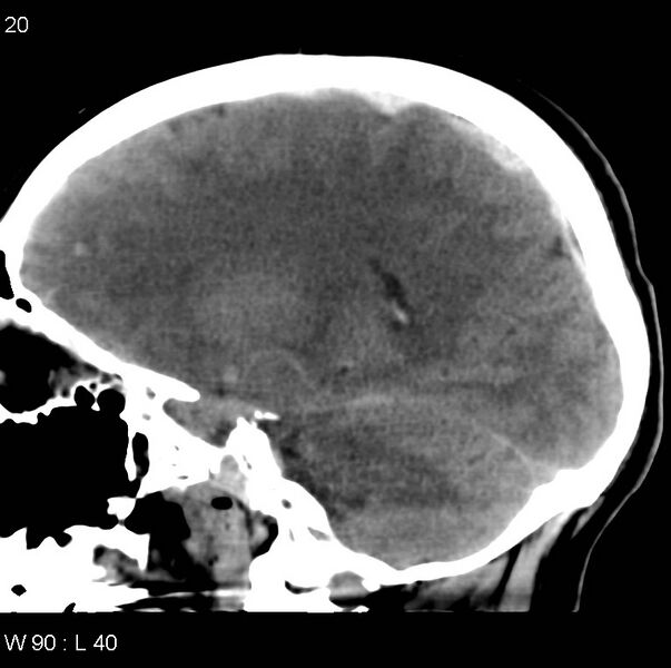 File:Cerebral hemorrhagic contusion with subdural and subarachnoid hemorrhage (Radiopaedia 10680-11146 C 13).jpg