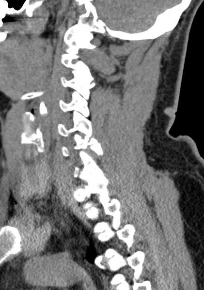 File:Cerebral hemorrhagic contusions and cervical spine fractures (Radiopaedia 32865-33841 G 45).jpg