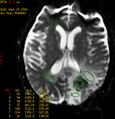 Cerebral radiation necrosis (Radiopaedia 5665-7376 Axial MR Perfusion 1).jpg