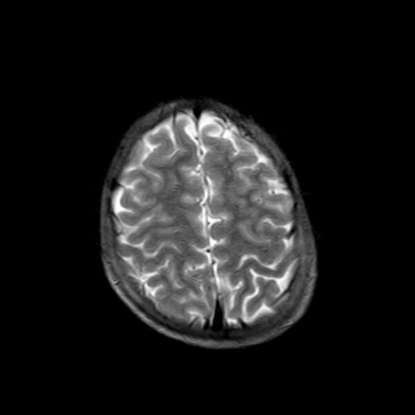 File:Cerebral tuberculoma (Radiopaedia 41152-43932 Axial T2 19).jpg