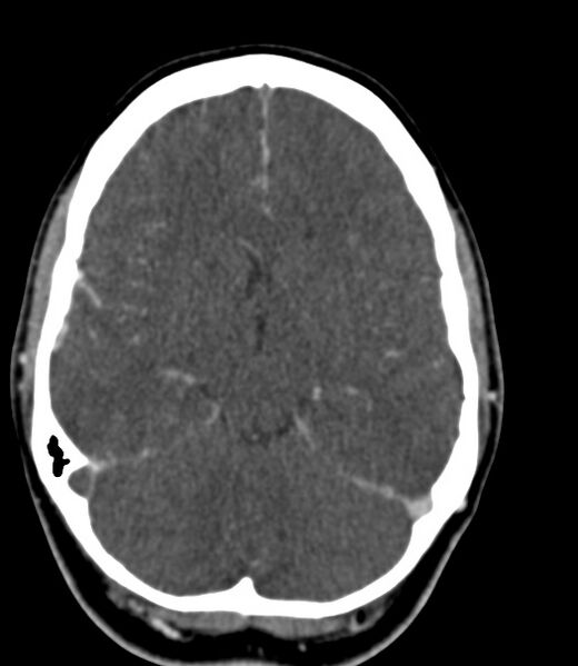 File:Cerebral venous sinus thrombosis (Radiopaedia 59224-66646 Axial C+ delayed 32).jpg