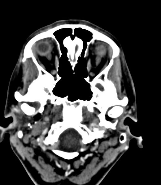 File:Cerebral venous sinus thrombosis (Radiopaedia 59224-66646 Axial C+ delayed 46).jpg