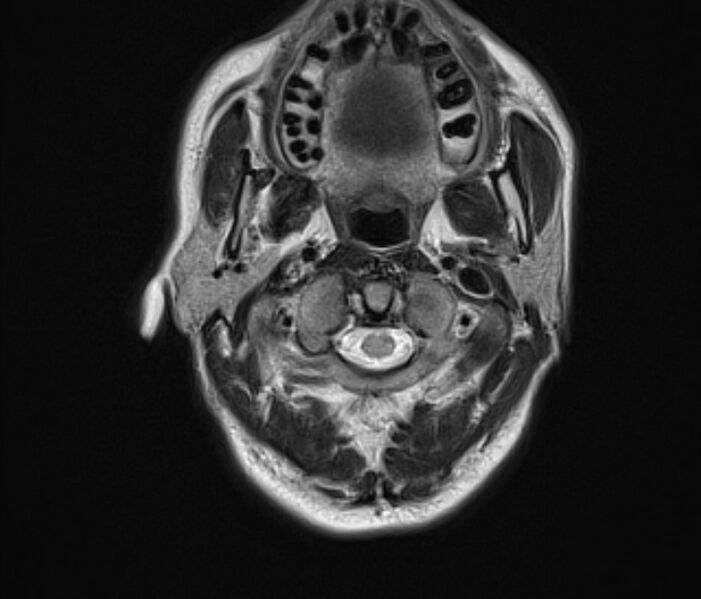 File:Cerebral venous thrombosis (Radiopaedia 71207-81504 Axial T2 1).jpg
