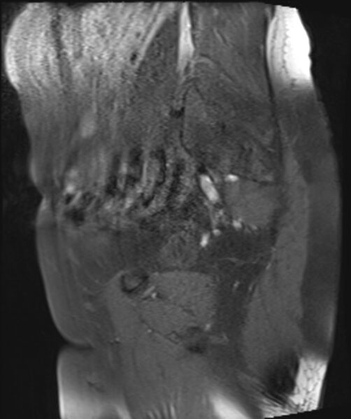 File:Cervical carcinoma (Radiopaedia 88312-104943 Sagittal T1 fat sat 9).jpg