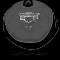 Cervical flexion teardrop fracture with cord hemorrhage (Radiopaedia 32497-33454 Axial bone window 33).jpg