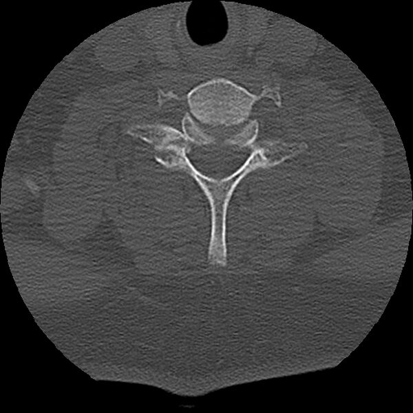 File:Cervical fracture and dislocation with locked facet (Radiopaedia 31837-32780 Axial bone window 13).jpg