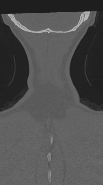 File:Cervical intercalary bone (Radiopaedia 35211-36748 Coronal bone window 77).png