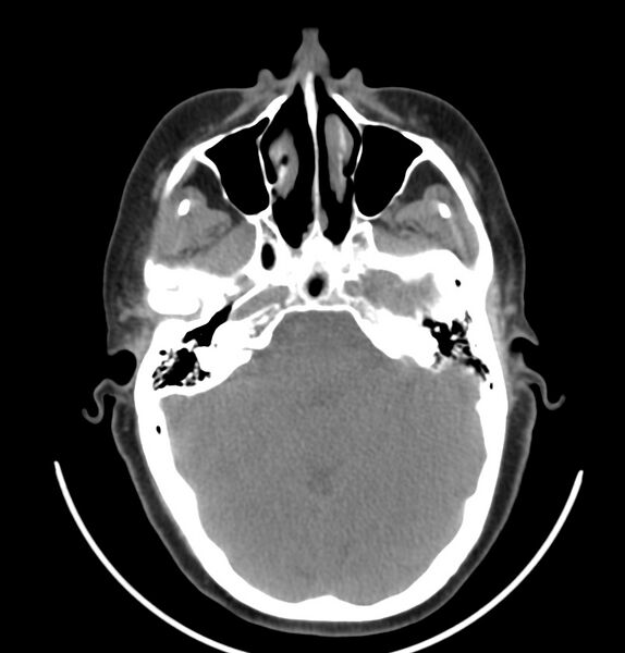 File:Cervical lymphadenopathy- cause unknown (Radiopaedia 22420-22457 non-contrast 40).jpg