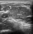 Cervical metastatic node (Radiopaedia 27565-27776 B 1).jpg
