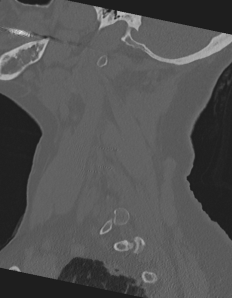 File:Cervical spine ACDF loosening (Radiopaedia 48998-54071 Sagittal bone window 22).png