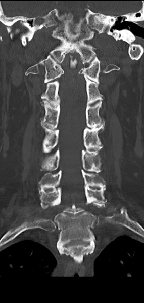 File:Cervical spine fracture - chalk stick (Radiopaedia 39116-41323 Coronal bone window 25).png