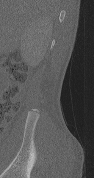File:Chance fracture (Radiopaedia 40360-42912 Sagittal bone window 98).png