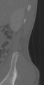 Chance fracture (Radiopaedia 40360-42912 Sagittal bone window 98).png