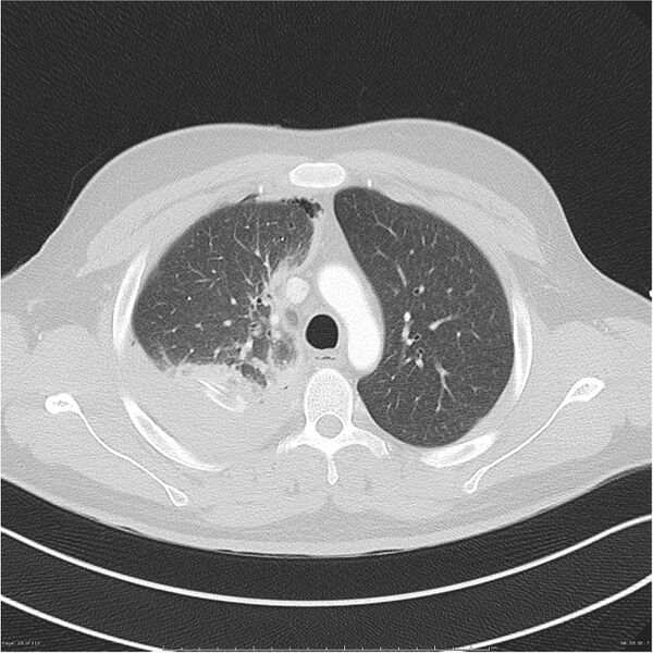 File:Chest stabbing (Radiopaedia 29089-29462 Axial lung window 28).jpg