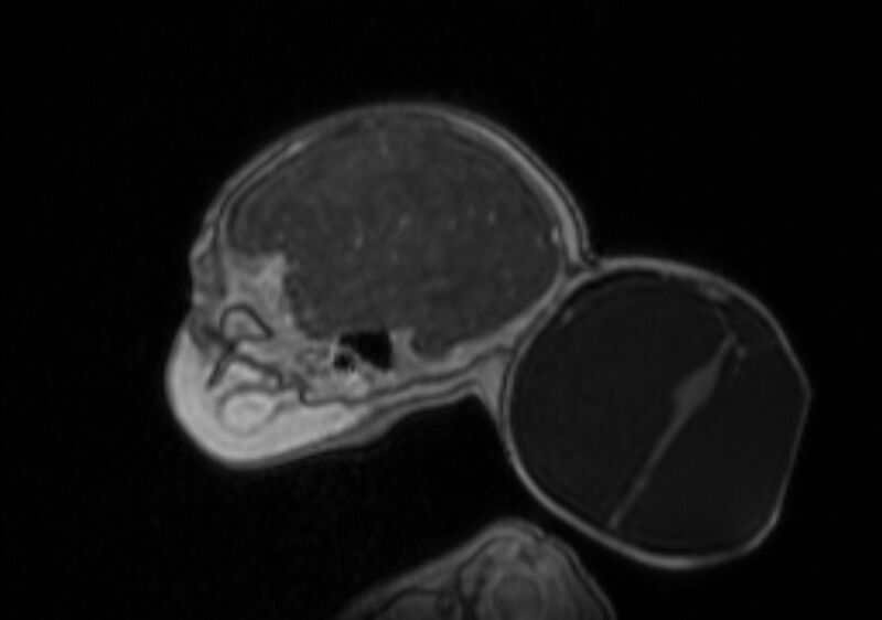File:Chiari III malformation with occipital encephalocele (Radiopaedia 79446-92559 Sagittal T1 C+ mpr 18).jpg