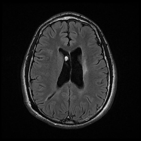 File:Chiasmatic-hypothalamic juvenile pilocytic astrocytoma (Radiopaedia 78533-91235 Axial FLAIR 18).jpg
