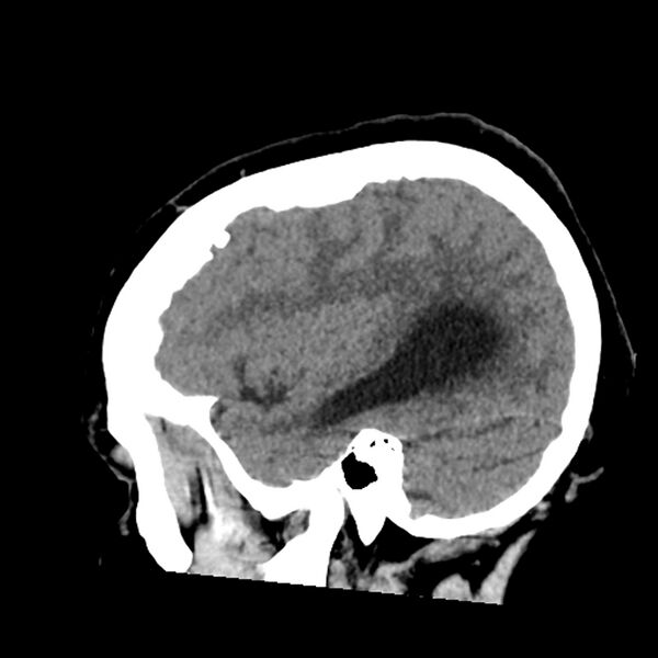 File:Chiasmatic-hypothalamic juvenile pilocytic astrocytoma (Radiopaedia 78533-91237 B 18).jpg