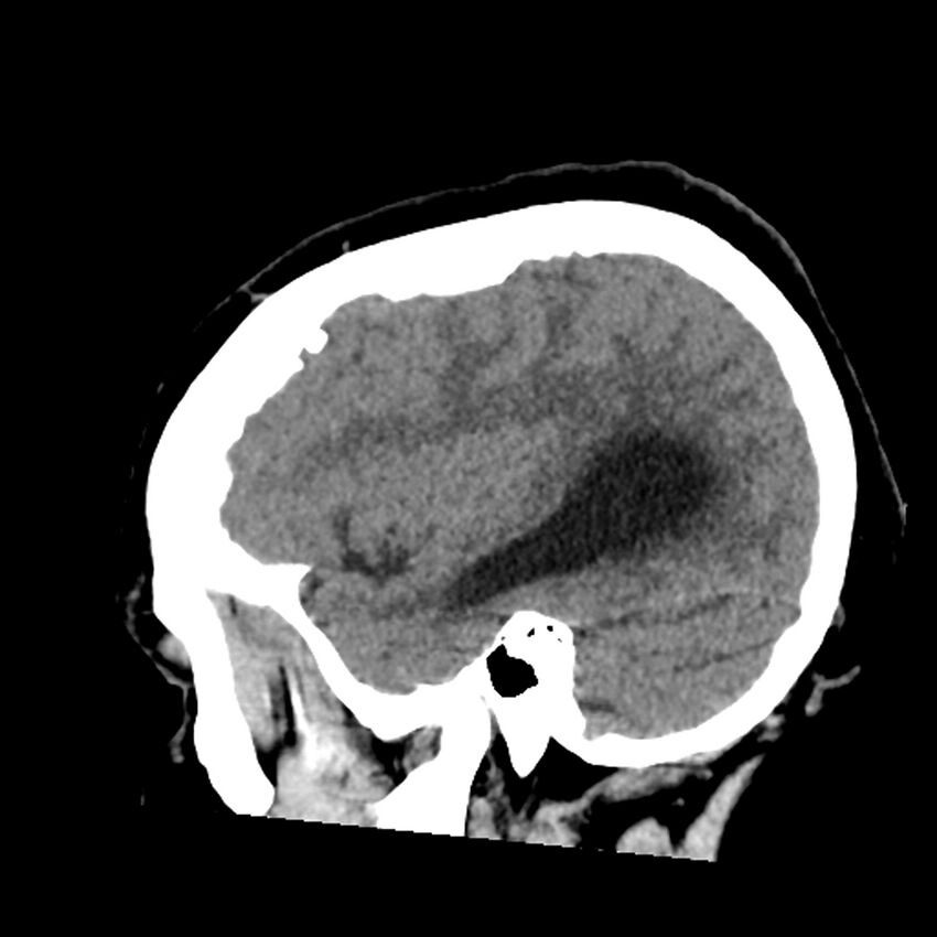 Chiasmatic-hypothalamic juvenile pilocytic astrocytoma (Radiopaedia 78533-91237 B 18).jpg