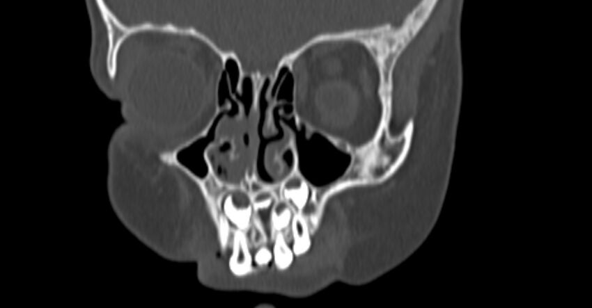 Choanal atresia (Radiopaedia 51295-56972 Coronal bone window 16).jpg