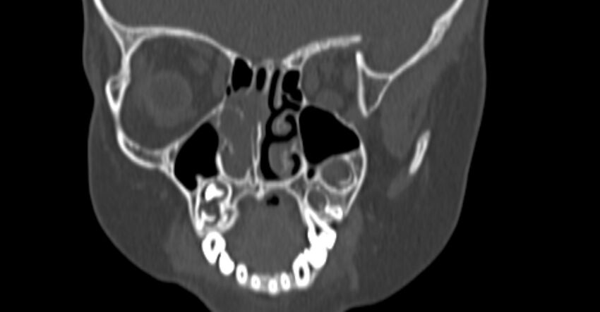 Choanal atresia (Radiopaedia 51295-56972 Coronal bone window 37).jpg