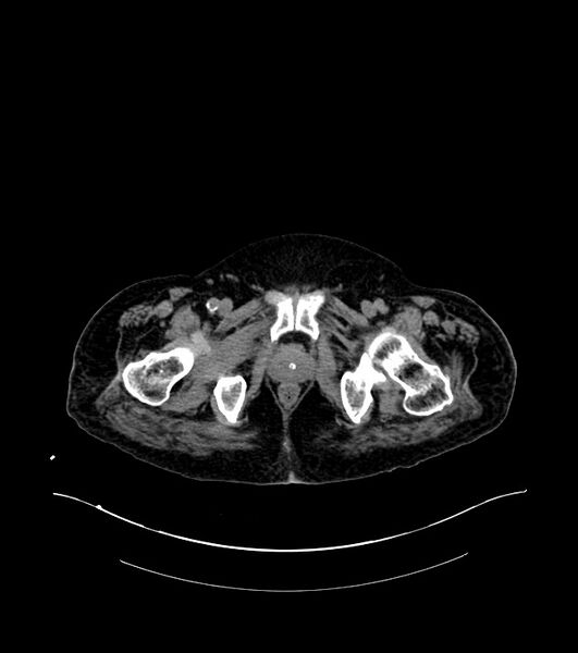 File:Cholangiocarcinoma with cerebral metastases (Radiopaedia 83519-98629 Axial non-contrast 128).jpg