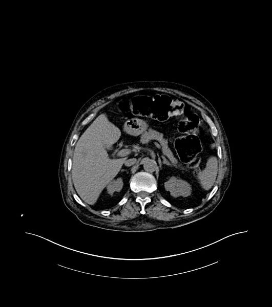 File:Cholangiocarcinoma with cerebral metastases (Radiopaedia 83519-98629 Axial non-contrast 28).jpg