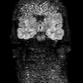 Cholesteatoma (Radiopaedia 10742-11204 Coronal DWI 7).jpg