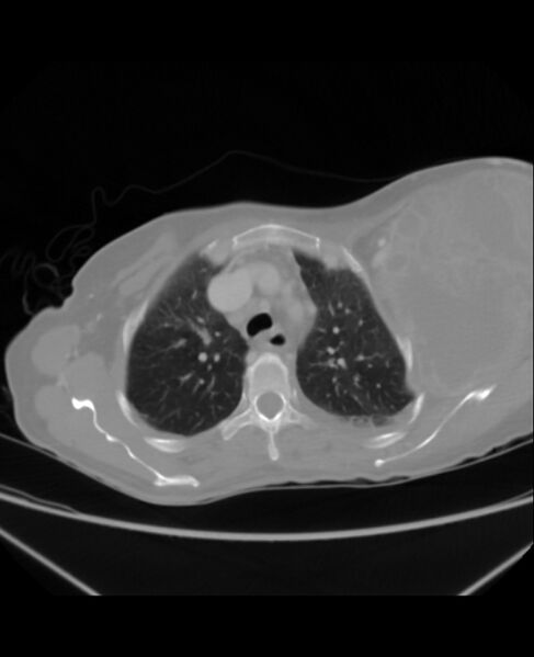 File:Chondrosarcoma (Radiopaedia 79427-92535 Axial lung window 13).jpg